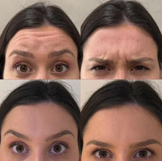 Toxina Botulínica - Antes e depois