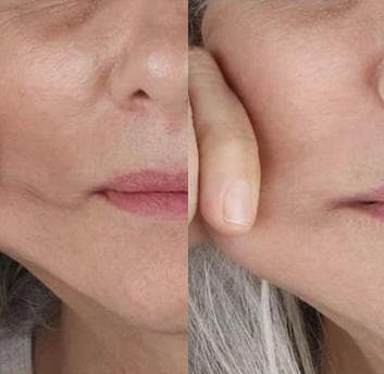 Bioestimulador de Colágeno - Antes e depois