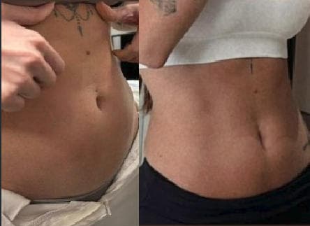 Lipo Enzimática - Antes e depois