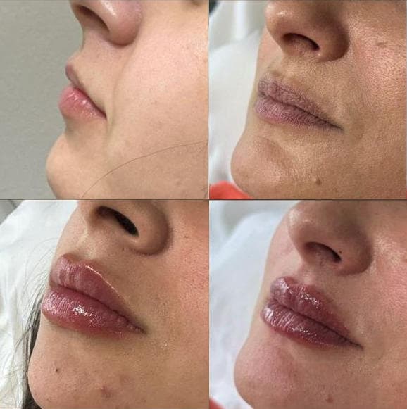 Preenchimento Labial - Antes e depois