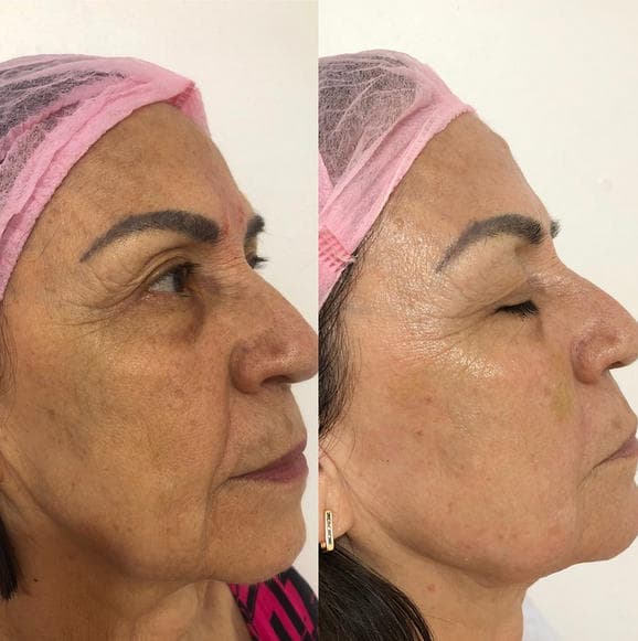 Skinbooster - Antes e depois